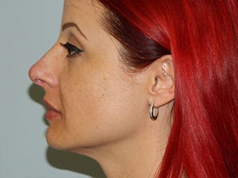 Non-Surgical Rhinoplasty and Injectable Fillers Before & After Gallery - Patient 133066557 - Image 4