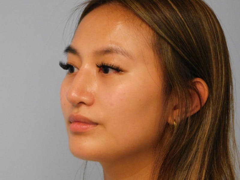 Chin Augmentation Before & After Gallery - Patient 133066555 - Image 8
