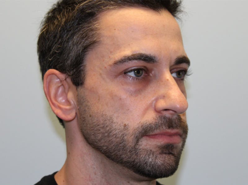 Rhinoplasty Before & After Gallery - Patient 133066561 - Image 5