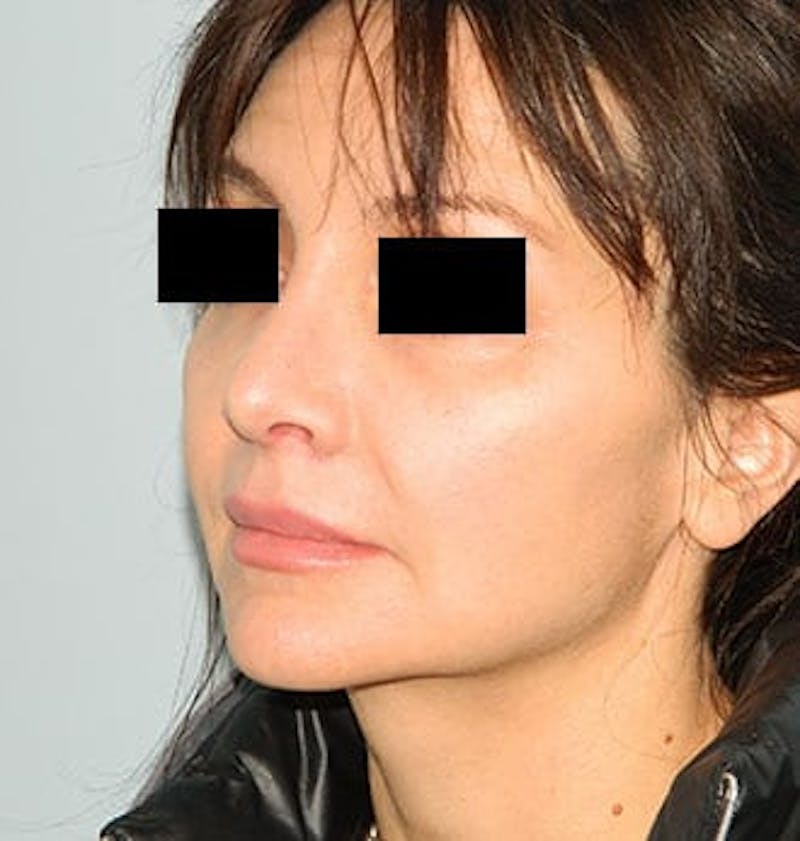 Revision Rhinoplasty Before & After Gallery - Patient 133066556 - Image 6