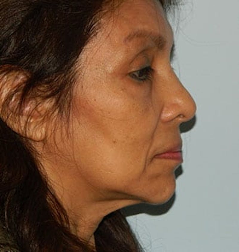 Mini-Facelift Before & After Gallery - Patient 133066558 - Image 5