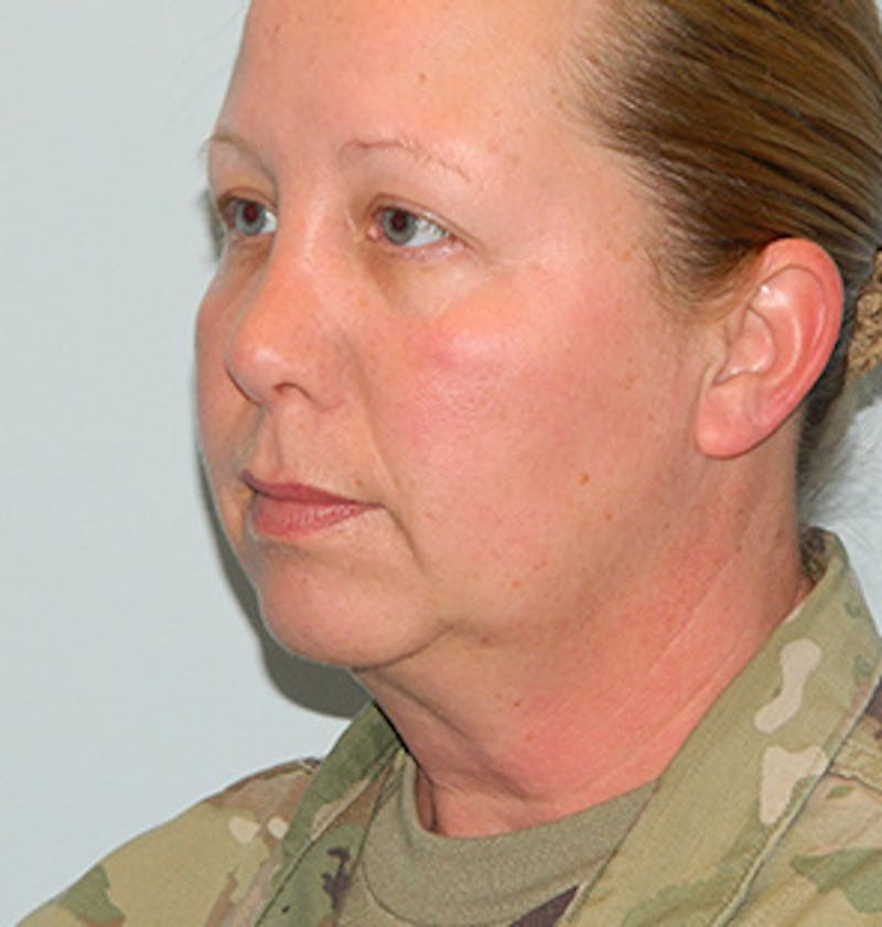 Facelift Before & After Gallery - Patient 133066560 - Image 5
