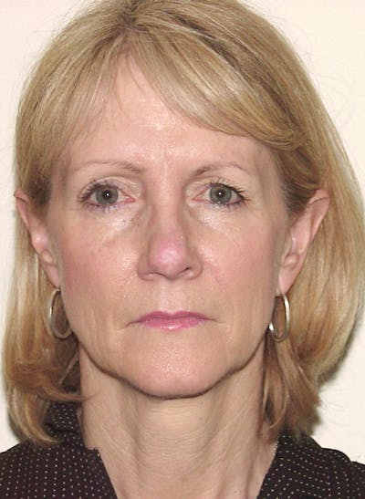 Blepharoplasty (Eyelid Lift) Before & After Gallery - Patient 133066559 - Image 1