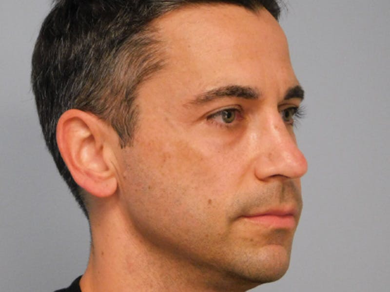 Rhinoplasty Before & After Gallery - Patient 133066561 - Image 6