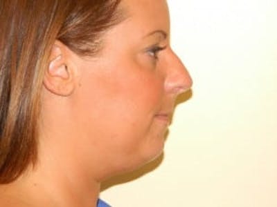 Chin Augmentation Before & After Gallery - Patient 133066563 - Image 1
