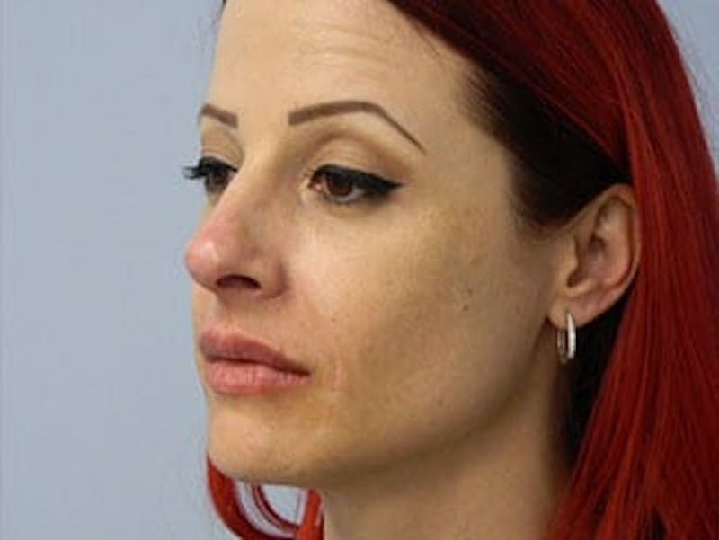 Non-Surgical Rhinoplasty and Injectable Fillers Before & After Gallery - Patient 133066557 - Image 6