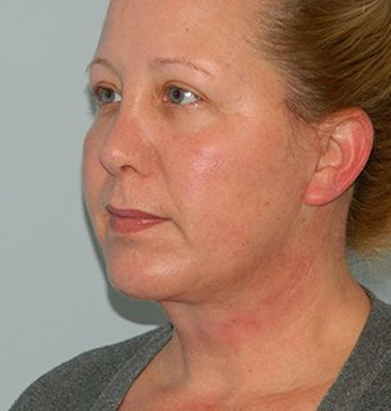 Facelift Before & After Gallery - Patient 133066560 - Image 6
