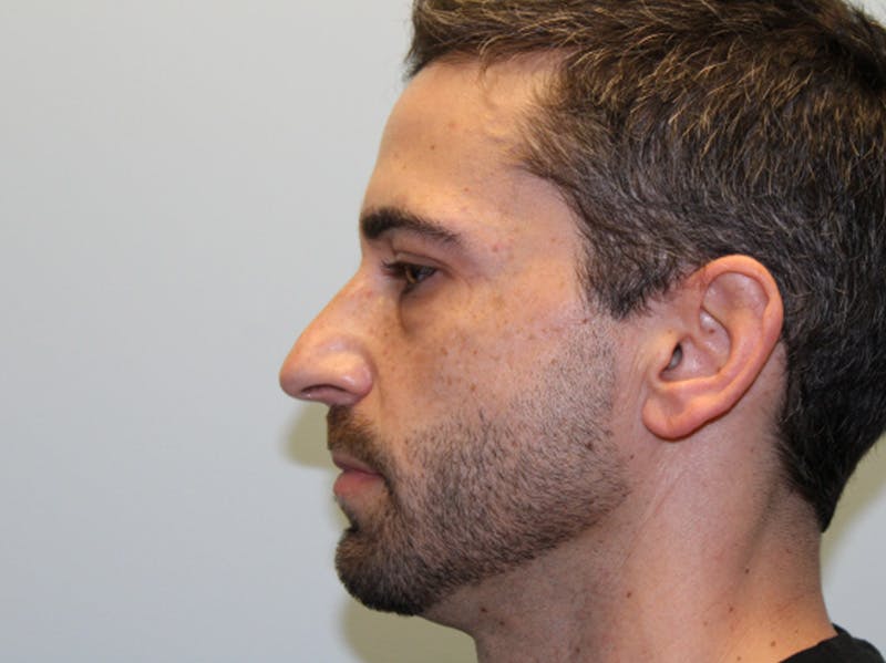 Rhinoplasty Before & After Gallery - Patient 133066561 - Image 7