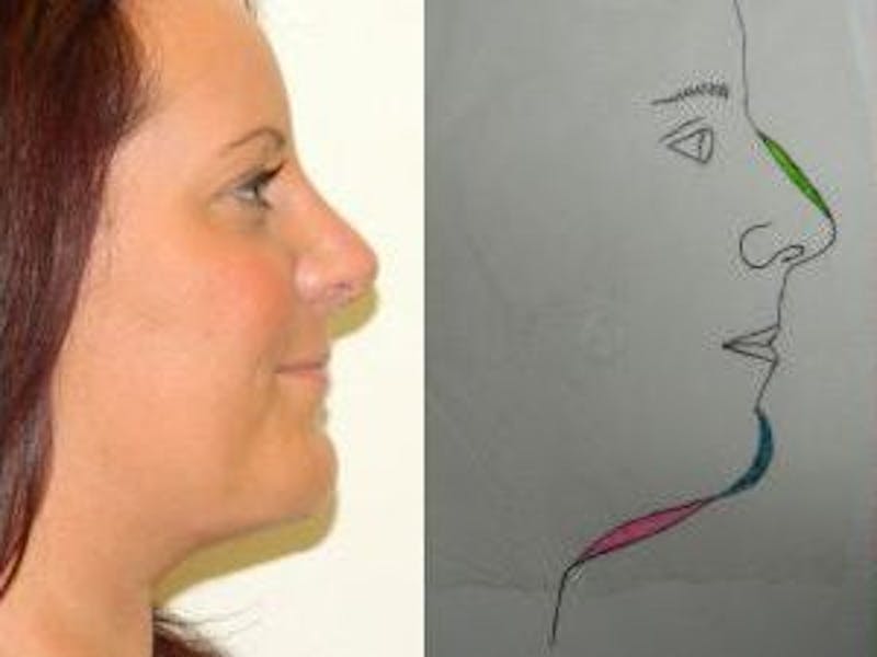 Chin Augmentation Before & After Gallery - Patient 133066563 - Image 2
