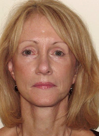 Blepharoplasty (Eyelid Lift) Before & After Gallery - Patient 133066559 - Image 2