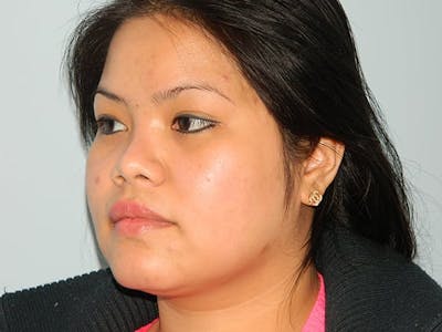 Non-Surgical Rhinoplasty and Injectable Fillers Before & After Gallery - Patient 133066566 - Image 1