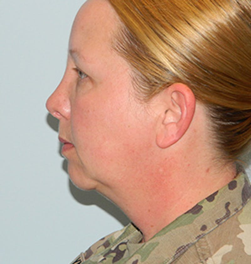 Facelift Before & After Gallery - Patient 133066560 - Image 7