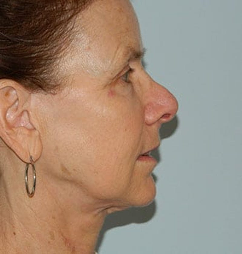 Mini-Facelift Before & After Gallery - Patient 133066562 - Image 1