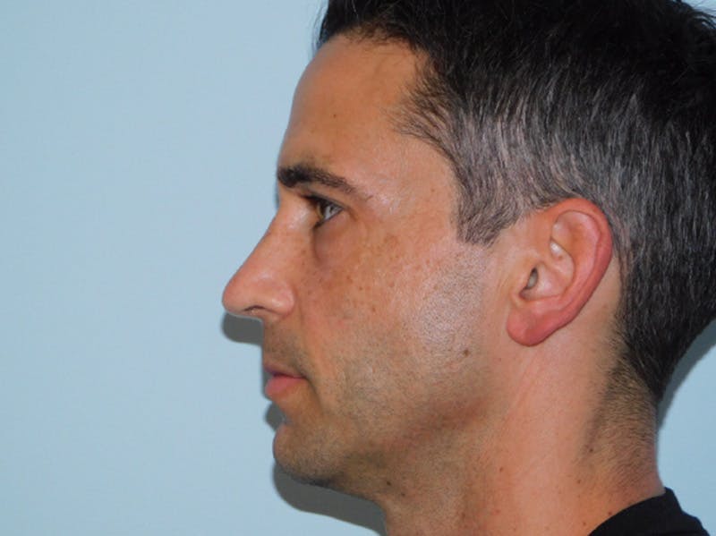 Rhinoplasty Before & After Gallery - Patient 133066561 - Image 8