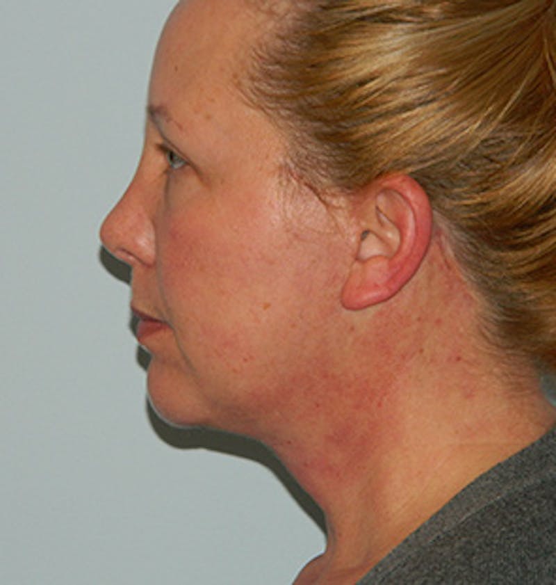 Facelift Before & After Gallery - Patient 133066560 - Image 8