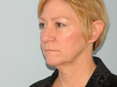 Blepharoplasty (Eyelid Lift) Before & After Gallery - Patient 133066567 - Image 1