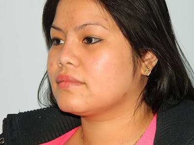 Non-Surgical Rhinoplasty and Injectable Fillers Before & After Gallery - Patient 133066566 - Image 2