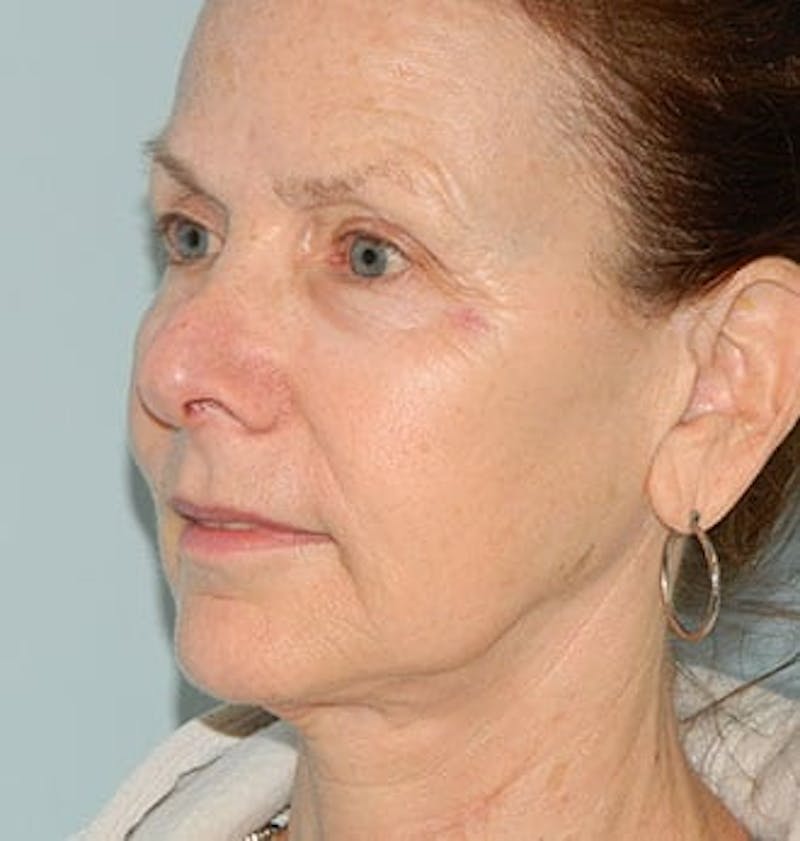 Mini-Facelift Before & After Gallery - Patient 133066562 - Image 3