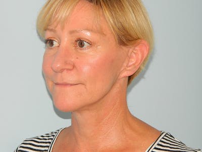 Blepharoplasty (Eyelid Lift) Before & After Gallery - Patient 133066567 - Image 2