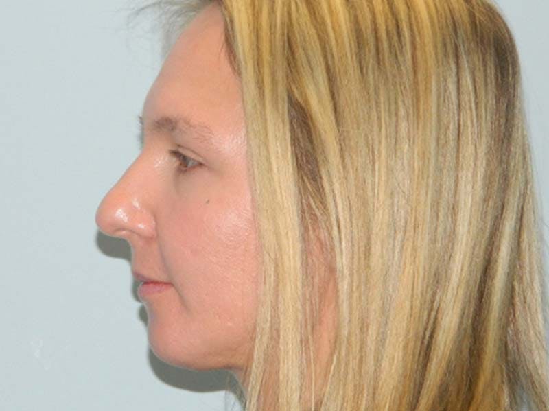 Rhinoplasty Before & After Gallery - Patient 133066568 - Image 1