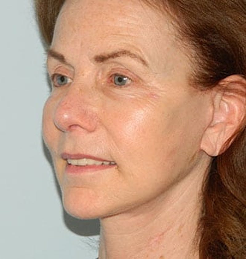 Mini-Facelift Before & After Gallery - Patient 133066562 - Image 4