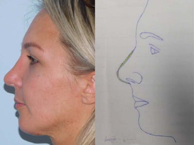 Rhinoplasty Before & After Gallery - Patient 133066568 - Image 2