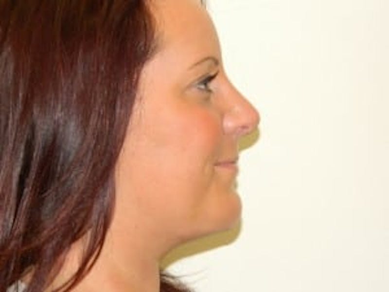 Chin Augmentation Before & After Gallery - Patient 133066563 - Image 6