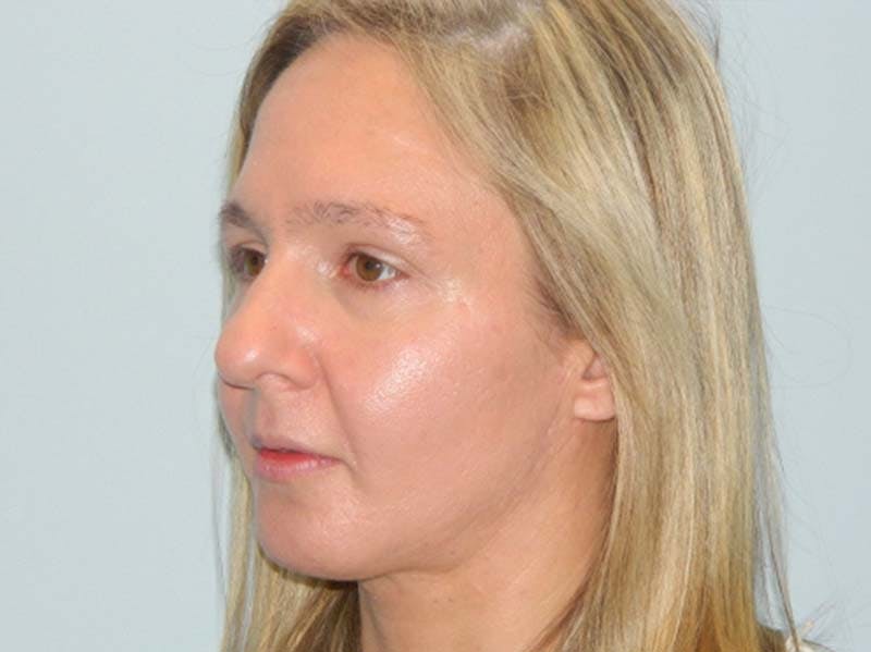 Rhinoplasty Before & After Gallery - Patient 133066568 - Image 3