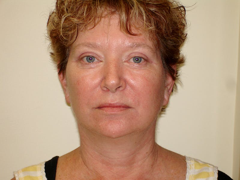 Facelift Before & After Gallery - Patient 133066570 - Image 2
