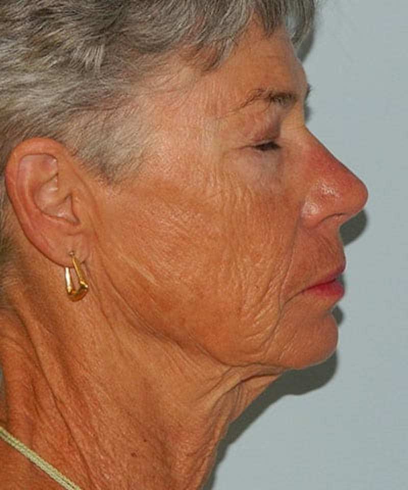 Mini-Facelift Before & After Gallery - Patient 133066569 - Image 1