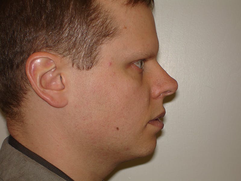 Chin Augmentation Before & After Gallery - Patient 133066576 - Image 1