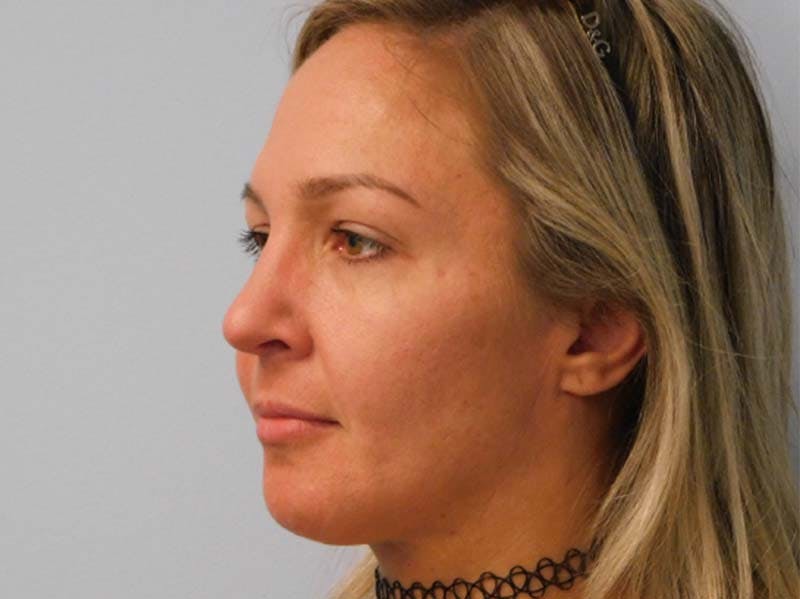 Rhinoplasty Before & After Gallery - Patient 133066568 - Image 4