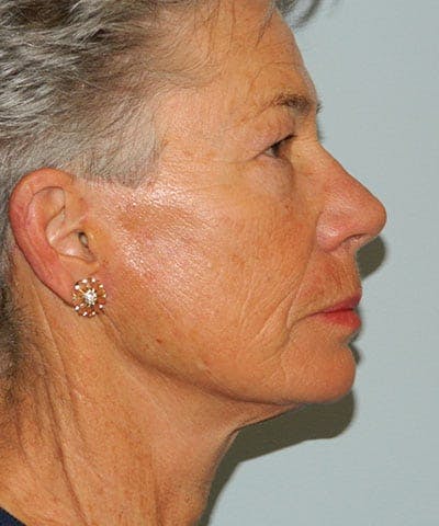 Mini-Facelift Before & After Gallery - Patient 133066569 - Image 2