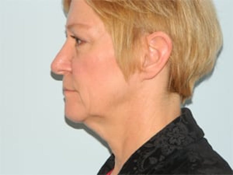 Blepharoplasty (Eyelid Lift) Before & After Gallery - Patient 133066567 - Image 5
