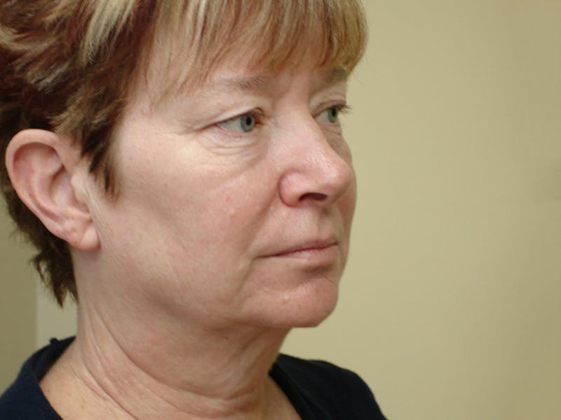 Facelift Before & After Gallery - Patient 133066570 - Image 3