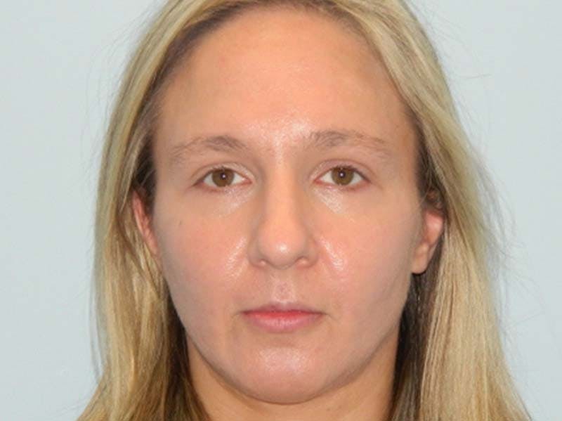 Rhinoplasty Before & After Gallery - Patient 133066568 - Image 5