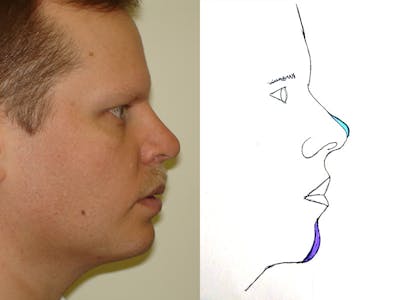 Chin Augmentation Before & After Gallery - Patient 133066576 - Image 2