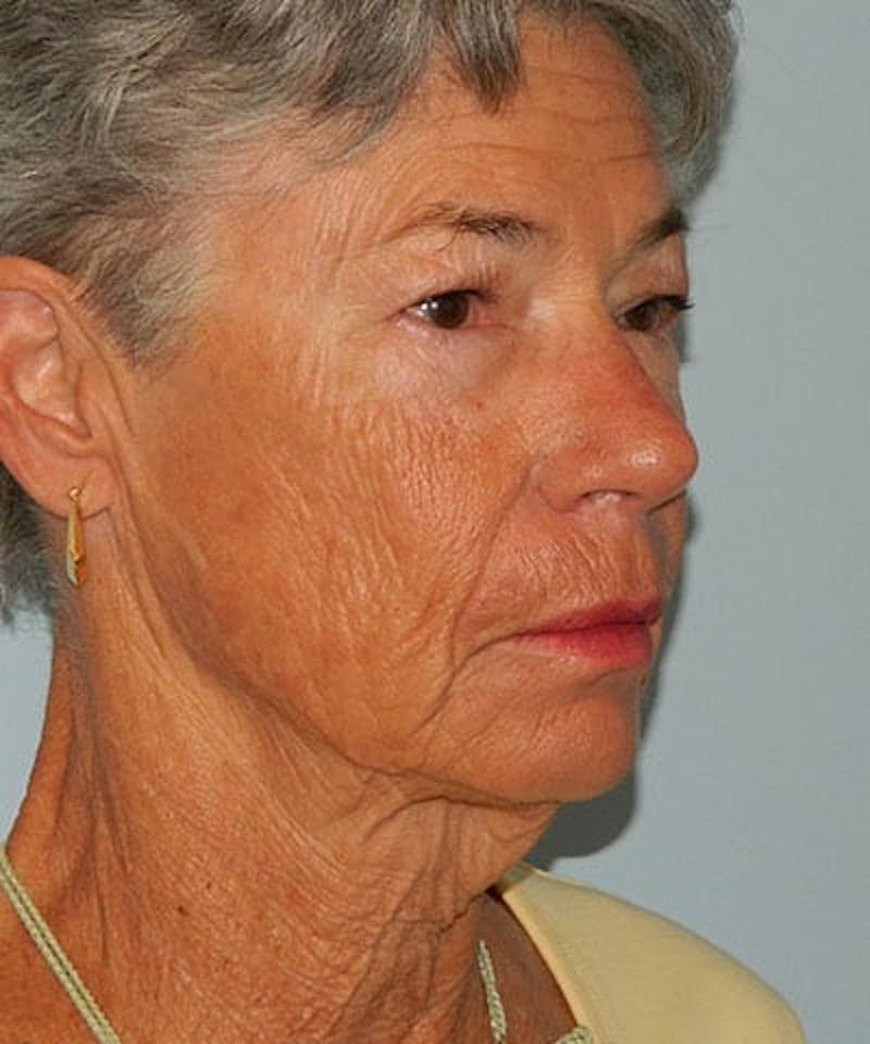 Mini-Facelift Before & After Gallery - Patient 133066569 - Image 3