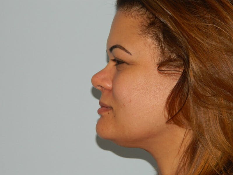 Non-Surgical Rhinoplasty and Injectable Fillers Before & After Gallery - Patient 133066572 - Image 1