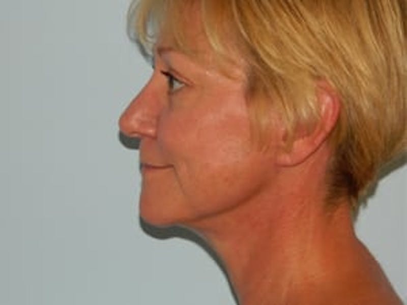 Blepharoplasty (Eyelid Lift) Before & After Gallery - Patient 133066567 - Image 6