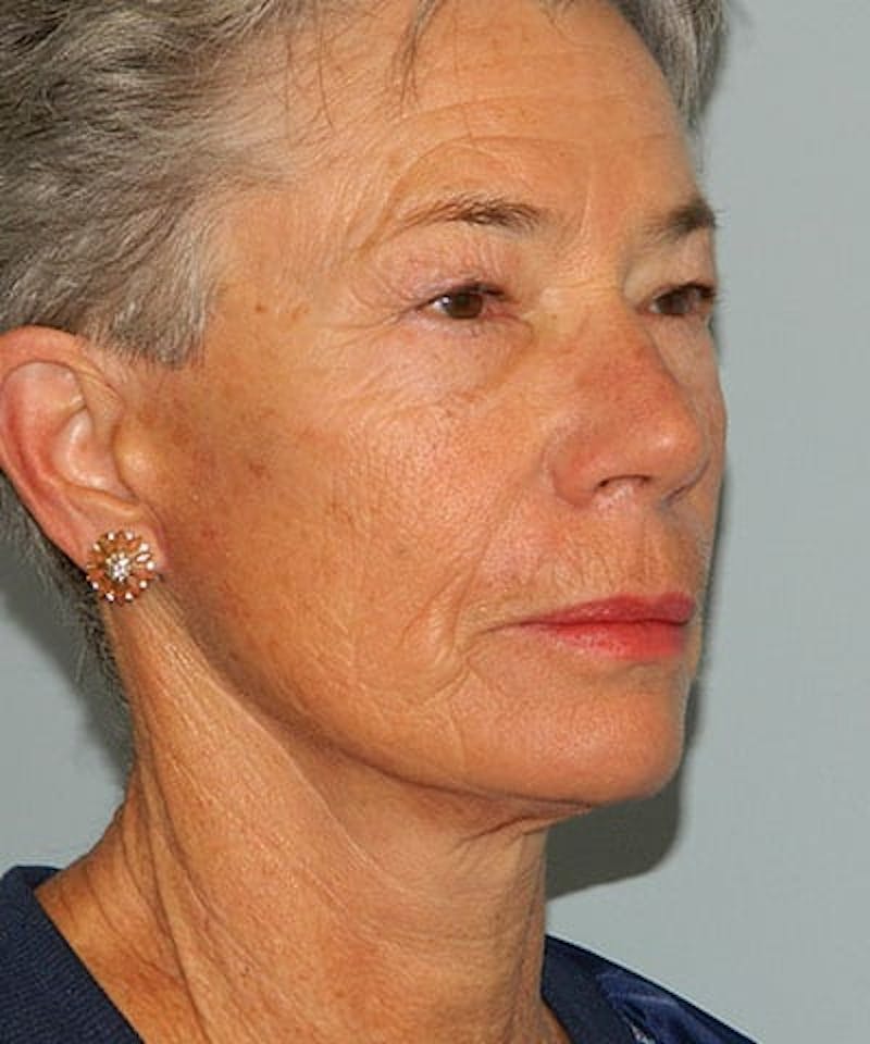 Mini-Facelift Before & After Gallery - Patient 133066569 - Image 4