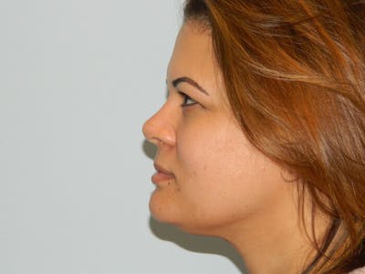 Non-Surgical Rhinoplasty and Injectable Fillers Before & After Gallery - Patient 133066572 - Image 2