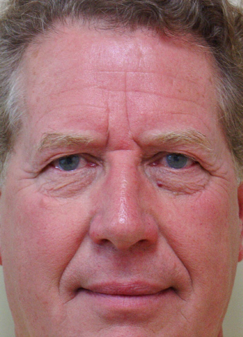 Blepharoplasty (Eyelid Lift) Before & After Gallery - Patient 133066571 - Image 1