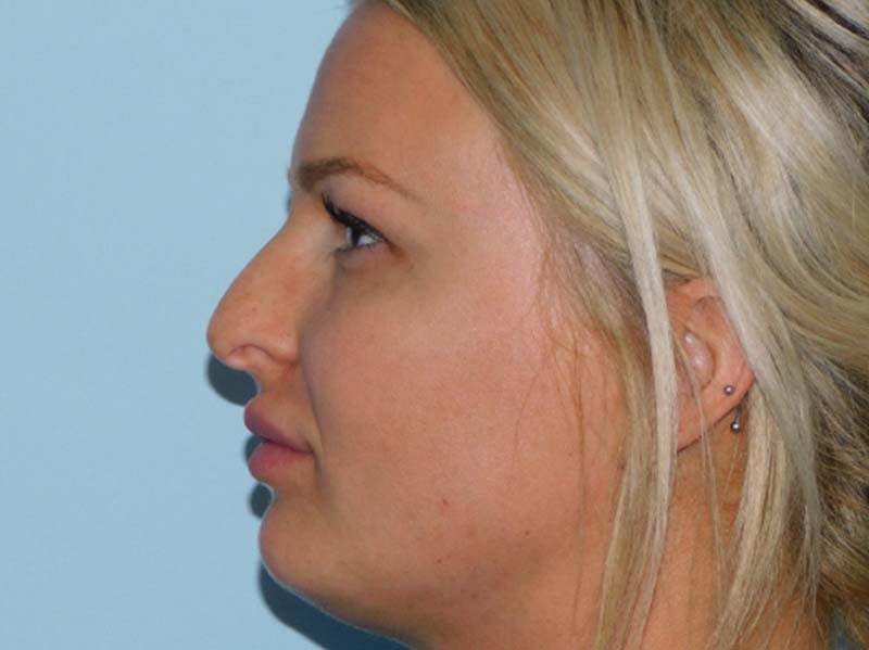 Rhinoplasty Before & After Gallery - Patient 133066575 - Image 1