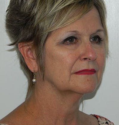 Mini-Facelift Before & After Gallery - Patient 133066573 - Image 1
