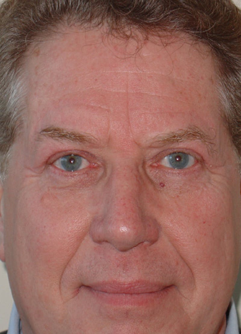 Blepharoplasty (Eyelid Lift) Before & After Gallery - Patient 133066571 - Image 2