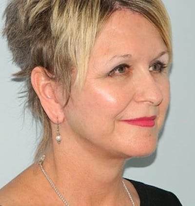 Mini-Facelift Before & After Gallery - Patient 133066573 - Image 2