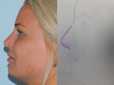 Rhinoplasty Before & After Gallery - Patient 133066575 - Image 2