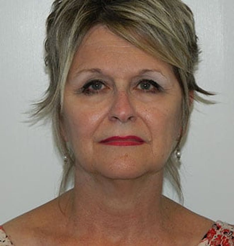 Mini-Facelift Before & After Gallery - Patient 133066573 - Image 3
