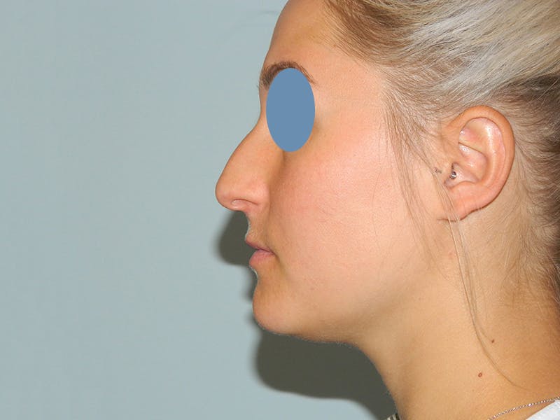Non-Surgical Rhinoplasty and Injectable Fillers Before & After Gallery - Patient 133066577 - Image 1